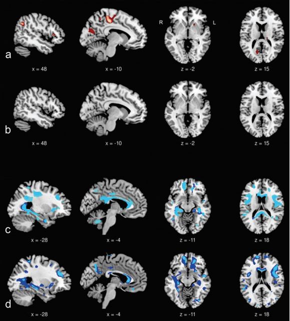 journal_nd's tweet photo. #openaccess review discussing the surprisingly common occurrence of brain-related symptoms in patients diagnosed with a muscle disease – check it out here: https://t.co/tmdLRdZpxo  @UniklinikBonn #DMD #myopathy #musculardystrophy #BMD #DM1 #FSHD https://t.co/C1AgzrqkcG