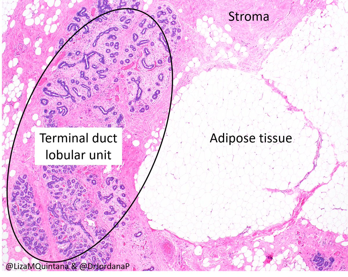 3/ Check out what this looks like on the pathology slide. And just to give some definitions: adipose tissue=breast fat, terminal duct lobular unit=glandular tissue, stroma=supporting structure of breast  #Breastpath