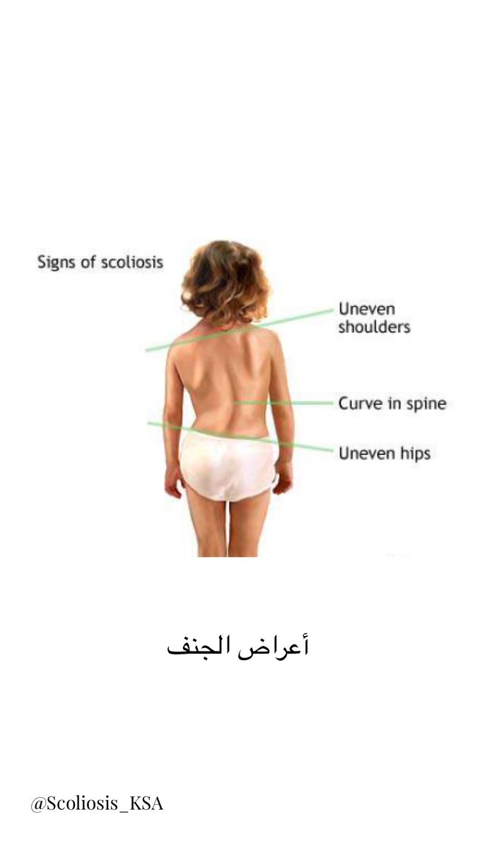 I have scoliosis (@Scoliosis_KSA) / Posts / X