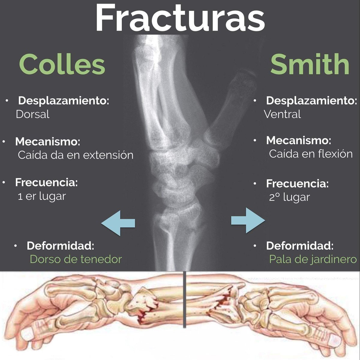 QuickMedicine1's tweet photo. Fractura de Colles y Fractura de Smith

#ENARM2020 #ENARM
#CursoENARM2020 #CTO #Proedumed 
#Traumatología
#TyO https://t.co/VvkUzRQDVb