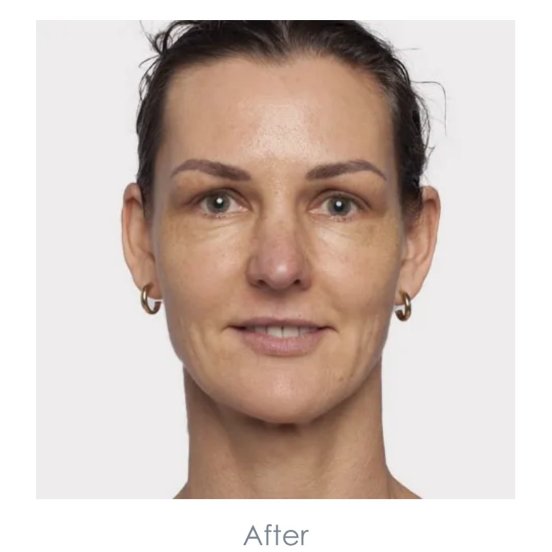 SkinBodyRenewal's tweet photo. Gerda van Tonder’s desire was to improve her hooded eyelids and to get a fresh and open expression. This was achieved through a non-surgical brow lift, targeted eye treatments https://t.co/OZnZym7Jh4
#SkinRenewalSA #RenewalInstitute #Mooimaak #Mooimaak2 #makeover #skin https://t.co/5tw4K5NrxE