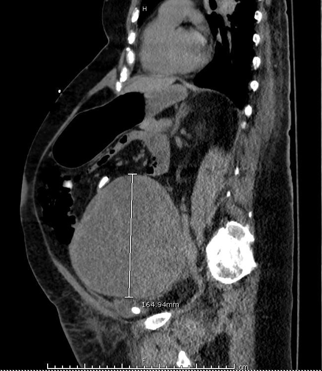 IndianaPath's tweet photo. 🔶Case of the Month🔶

Post-menopausal woman with large ovarian mass:

🔹Primitive cells
🔹Rossettes
🔹(+) CK AE1/AE3, EMA, NSE

What's your diagnosis?

➡️For additional history, images and discussion: https://t.co/9Ij5ePHjle

Contributors: @AndrewTharpMD1 
@SheilaSegura3 https://t.co/jiwmk55nwo