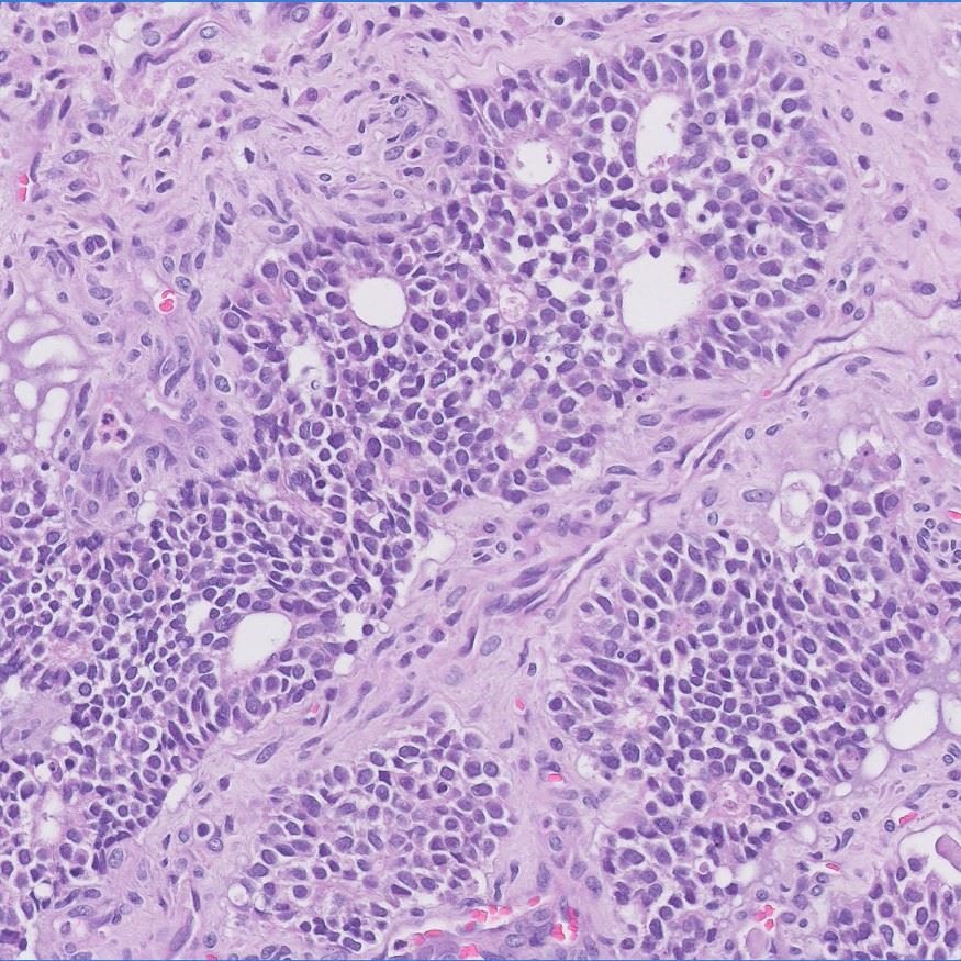IndianaPath's tweet photo. 🔶Case of the Month🔶

Post-menopausal woman with large ovarian mass:

🔹Primitive cells
🔹Rossettes
🔹(+) CK AE1/AE3, EMA, NSE

What's your diagnosis?

➡️For additional history, images and discussion: https://t.co/9Ij5ePHjle

Contributors: @AndrewTharpMD1 
@SheilaSegura3 https://t.co/jiwmk55nwo
