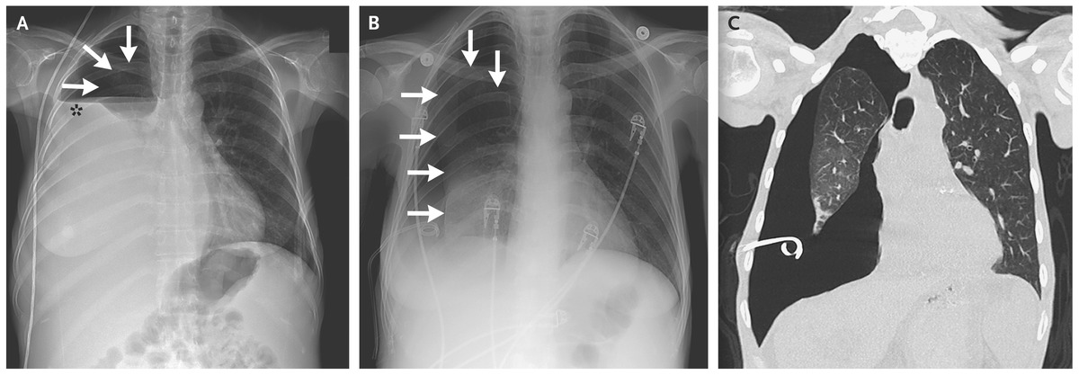 Pleuritis is common and generally associated with small effusions if present. This may be eventually complicated by fibrothorax w/ Trapped Lung Syndrome.  https://www.nejm.org/doi/full/10.1056/nejmicm1404964