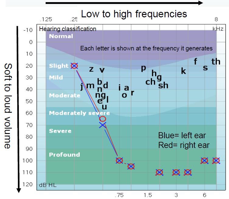 2/9 My hearing loss (since childhood) spans a slight loss in low frequencies to profound hearing loss in the highs, as shown. In simple terms, I cannot hear many consonants (which is what ppl recognise speech with), I recognise speech by vowels and heavily rely on lip reading.