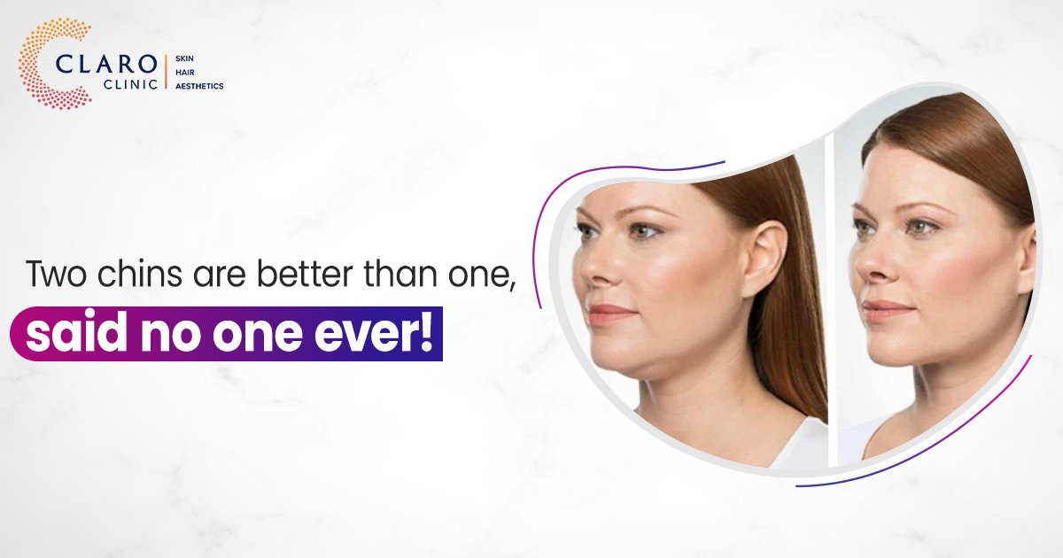 Do you feel annoyed every time you look at yourself in the mirror and spot that double chin? Well, fret not! Visit Claro clinic today and get rid of your double chin now.
#Claroclinic
#antiaging #skin #skincare #doublechintreatment #beauty  #vocalforlocal #loveyourskin
