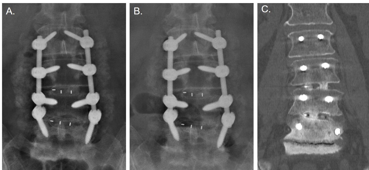 We have launched a clinical study for our titanium-integrated interbody devices providing neuro- and orthopedic spine surgeons in the U.S. and Europe with clinical data that supports the safety and effectiveness of these devices. prn.to/2SrqzQq