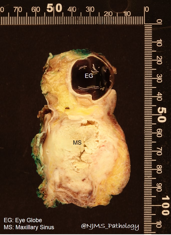 🚩Left maxillary sinus lesion with orbital extension.
🚩Specimen: left maxillectomy with orbital exenteration.
🚩Dx: Moderately differentiated squamous cell carcinoma.
<a href="/NJMS_Pathology/">Rutgers NJMS Pathology</a> <a href="/KAlgarrahi/">Khalid Algarrahi, MD</a>