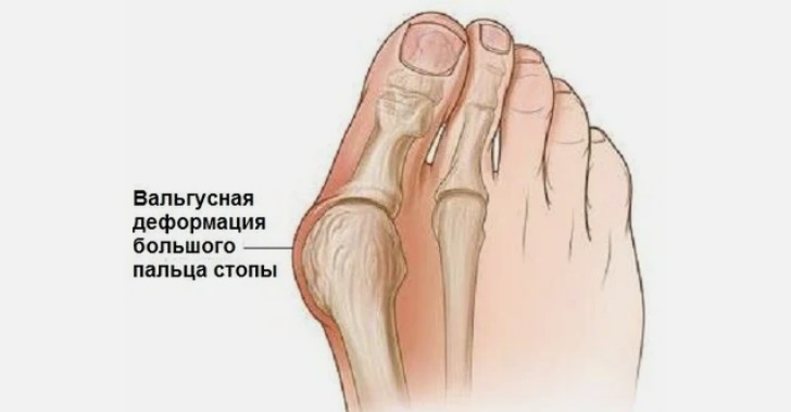 Домашний крем от косточки на ноге: fitobox.ru/domashnij-krem…