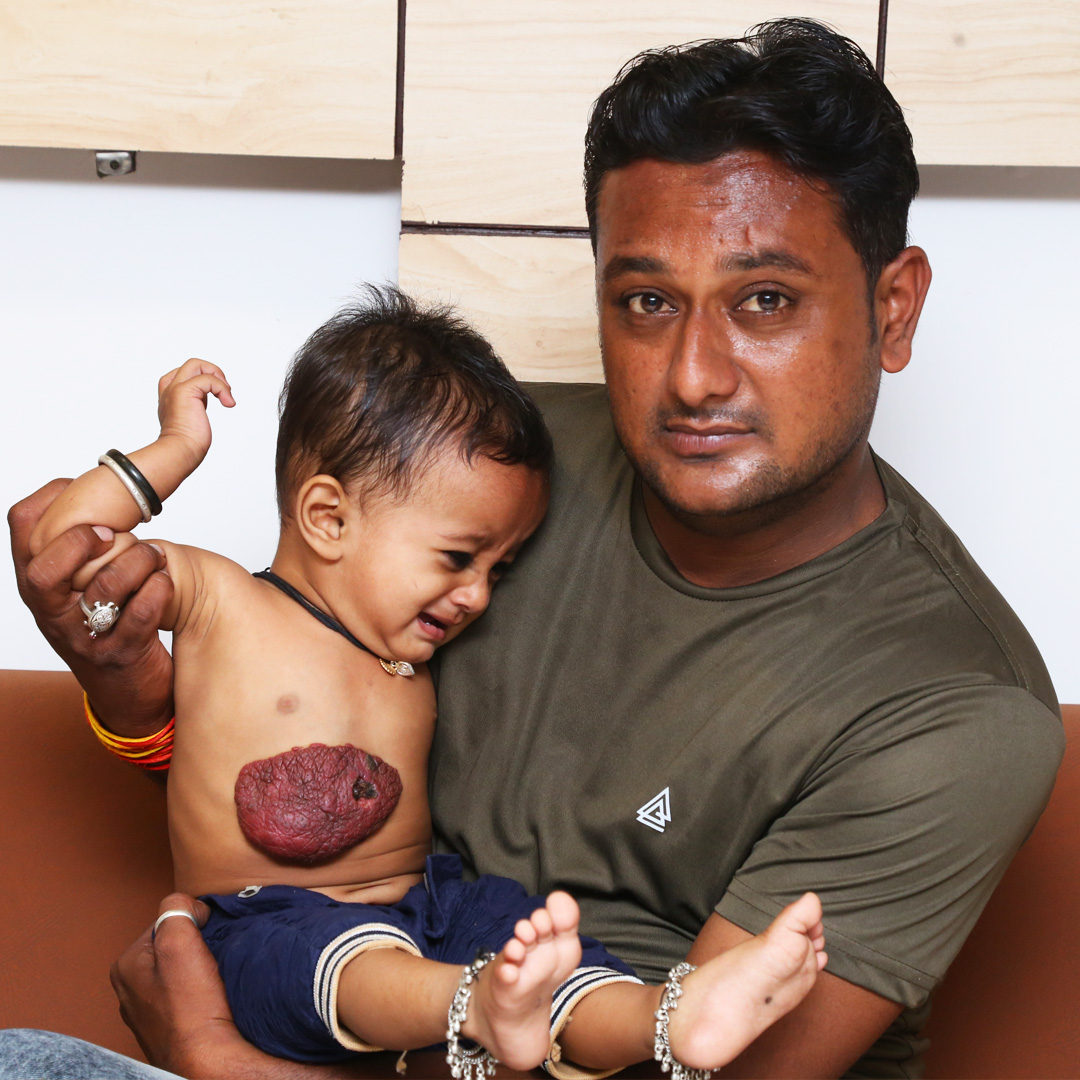 ketto's tweet photo. My baby girl cries in pain all the time, pointing at the huge black growth near her chest. The rare disease has made her miserable, &amp; it breaks my heart to know that I will never be able to afford her treatment on a priest’s income.

Please help her here: https://t.co/3ETVixqm1F https://t.co/vlaIebl4Ys