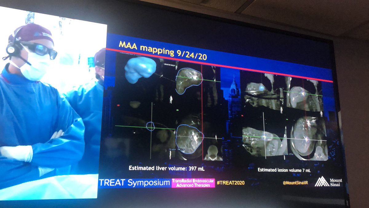yourchocdoc's tweet image. Between #LEARN2020, call, &amp;amp; now #TREAT2020 underway it’s been an exciting few days @MountSinaiIR. Transradial #endoleak repair, splenic artery embolization &amp;amp; y90 #TARE coming up now!  Tune in now!