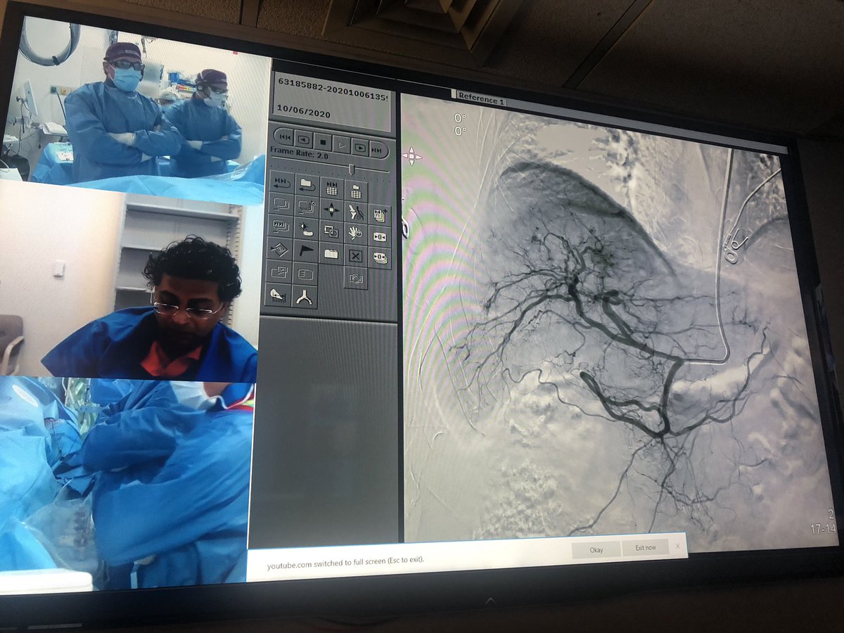 yourchocdoc's tweet image. Between #LEARN2020, call, &amp;amp; now #TREAT2020 underway it’s been an exciting few days @MountSinaiIR. Transradial #endoleak repair, splenic artery embolization &amp;amp; y90 #TARE coming up now!  Tune in now!