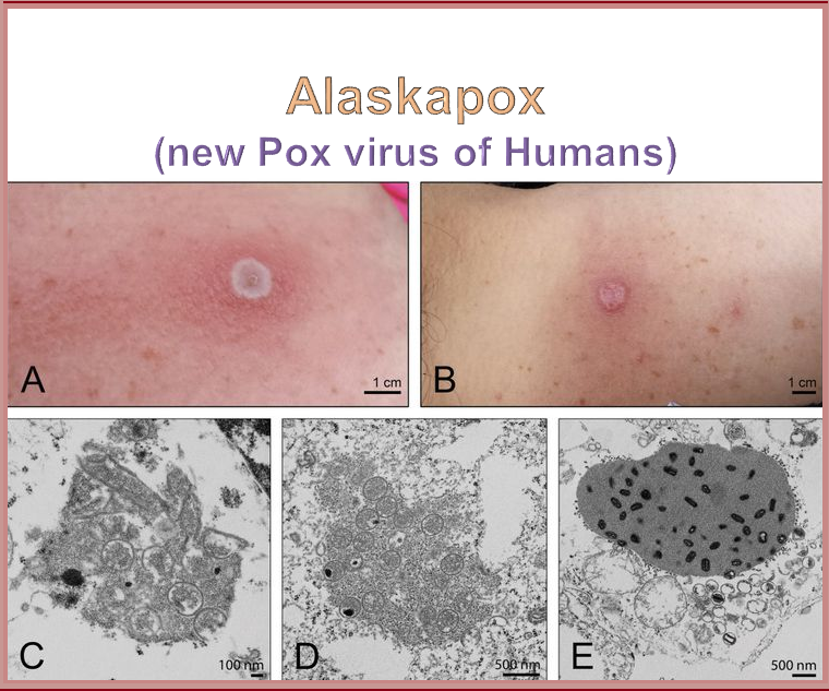 A woman in Fairbanks Alaska presented with a mysterious grey lesion on her left upper arm, along with shoulder pain, fatigue, and a fever.  On 20 Sept it was confirmed that she has the 2nd-ever known case of a new virus, "#Alaskapox," a member of the same genus as smallpox.