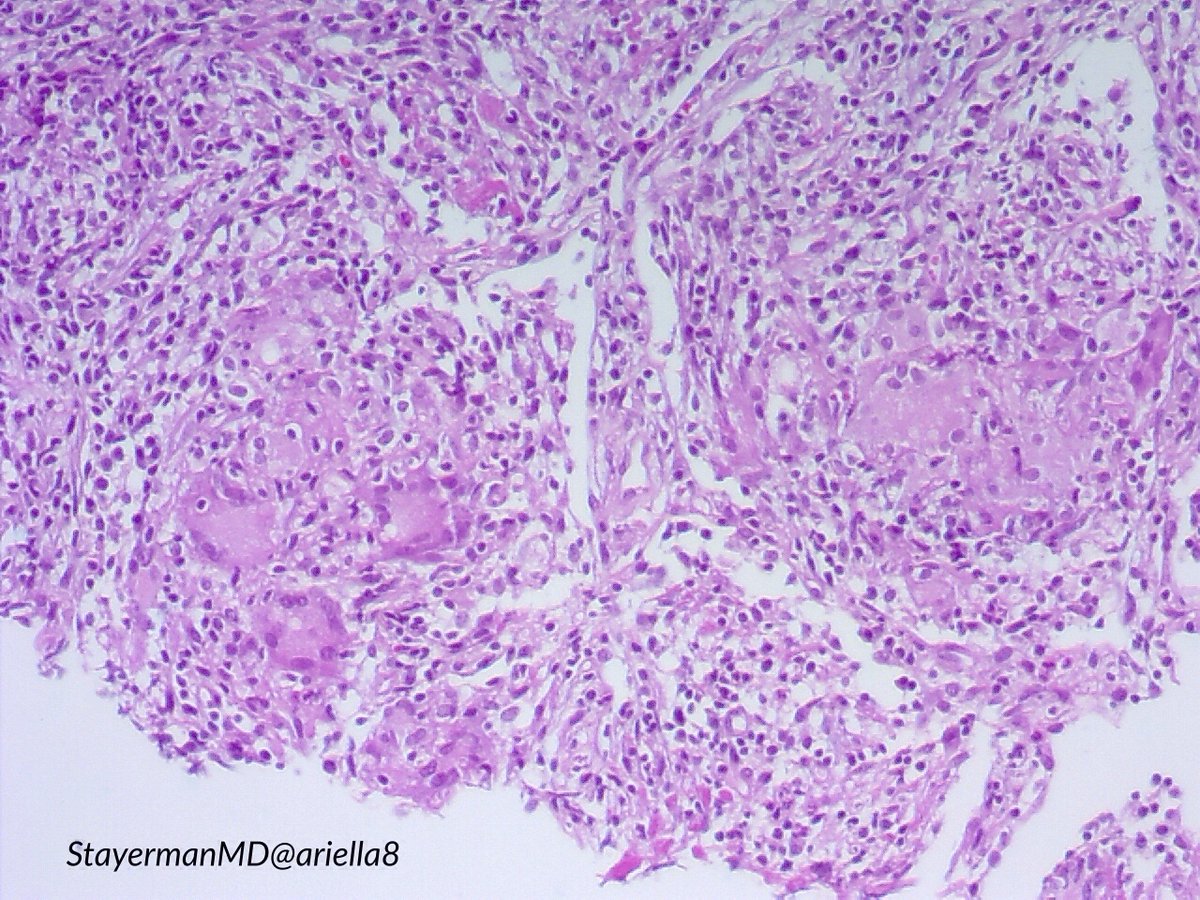 ariella8's tweet image. #Pulmpath #Thoracicpath #Pathbugs 1/2
Excited again to share a case that crossed my microscope 
Peripheral pleural based masses, sent with DX Ca versus round pneumonia (up to 5 cm ).
It is part of  #Pathtweeter history 
Look at the first set ,make your DX , then go to 2nd 👉
