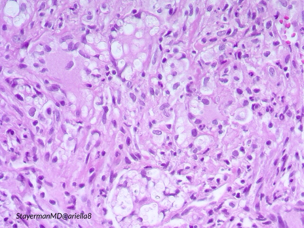 ariella8's tweet image. #Pulmpath #Thoracicpath #Pathbugs 1/2
Excited again to share a case that crossed my microscope 
Peripheral pleural based masses, sent with DX Ca versus round pneumonia (up to 5 cm ).
It is part of  #Pathtweeter history 
Look at the first set ,make your DX , then go to 2nd 👉