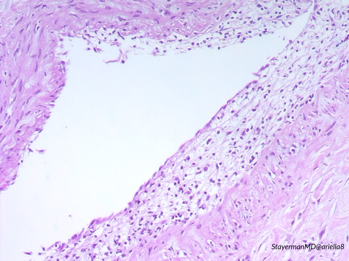ariella8's tweet image. #Pulmpath #Thoracicpath #Pathbugs 1/2
Excited again to share a case that crossed my microscope 
Peripheral pleural based masses, sent with DX Ca versus round pneumonia (up to 5 cm ).
It is part of  #Pathtweeter history 
Look at the first set ,make your DX , then go to 2nd 👉