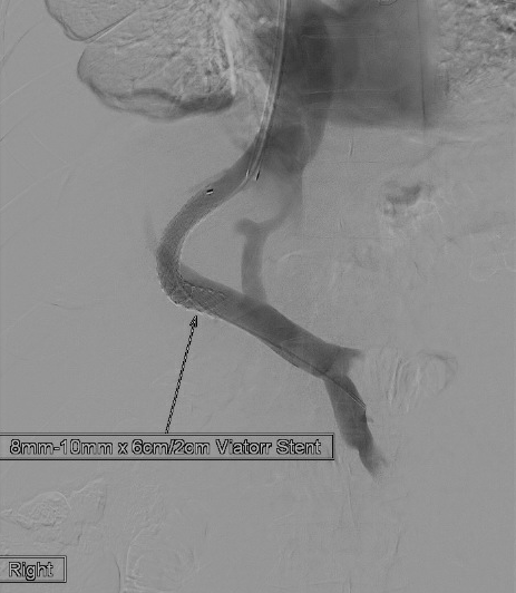 urmed_ir's tweet photo. CO2 TIPS for recurrent ascites. Check out that perfect roadmap, too easy!! #IRad #TwittIR #Interventional #Radiology #BasicIR https://t.co/F6nv3LBMHb
