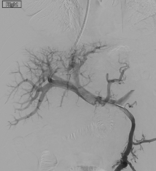 urmed_ir's tweet photo. CO2 TIPS for recurrent ascites. Check out that perfect roadmap, too easy!! #IRad #TwittIR #Interventional #Radiology #BasicIR https://t.co/F6nv3LBMHb