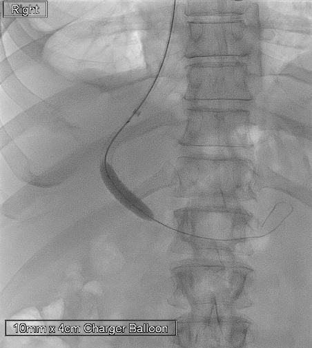 urmed_ir's tweet photo. CO2 TIPS for recurrent ascites. Check out that perfect roadmap, too easy!! #IRad #TwittIR #Interventional #Radiology #BasicIR https://t.co/F6nv3LBMHb