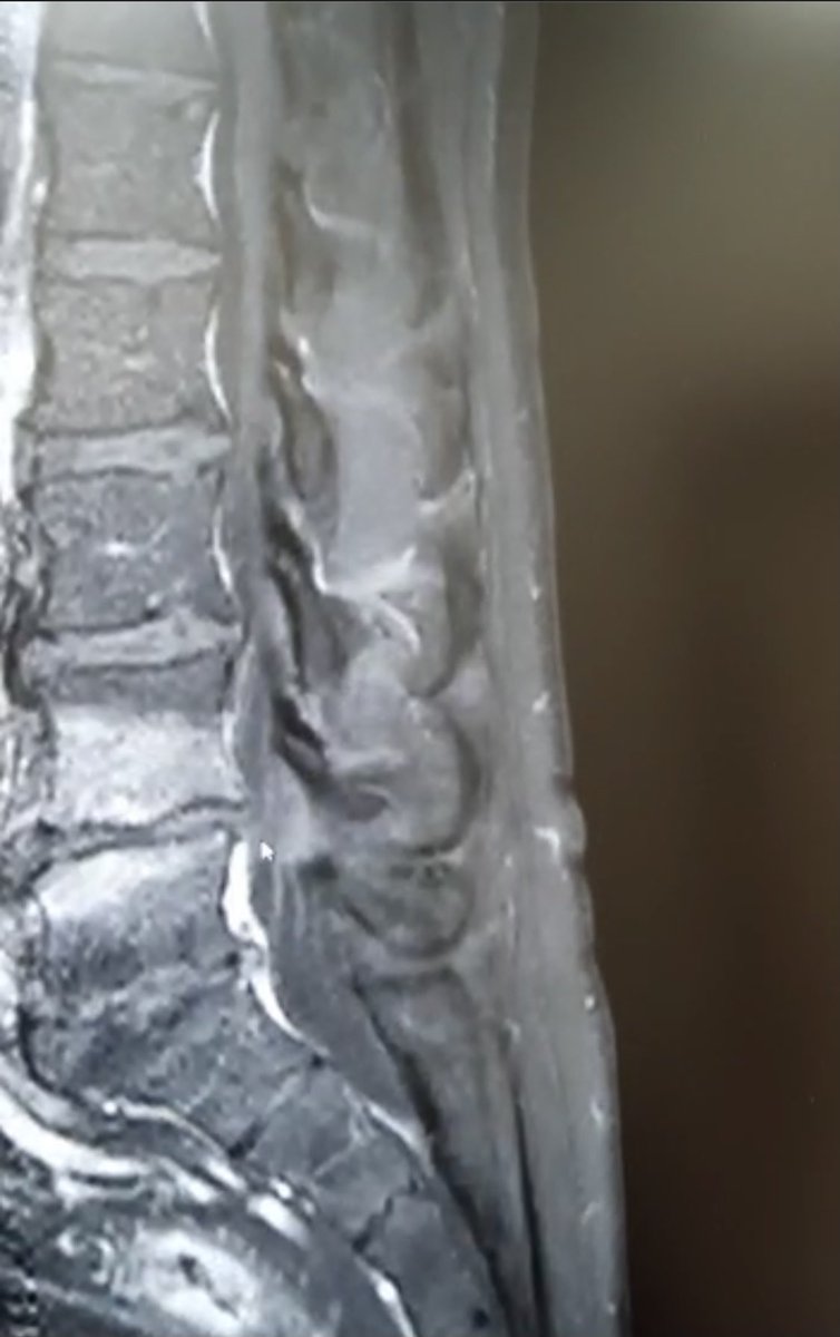 Young patient with lower backache. T2, T1, STIR and post-Gd Sagittal images- shows marrow edema involving the L4-5 vertebral end plates(L4&gt;L5) with enhancement on Gd administration. L4-5 disc hyperintensity is also noted without enhancement. Modic type 1 or spondylodiskitis?