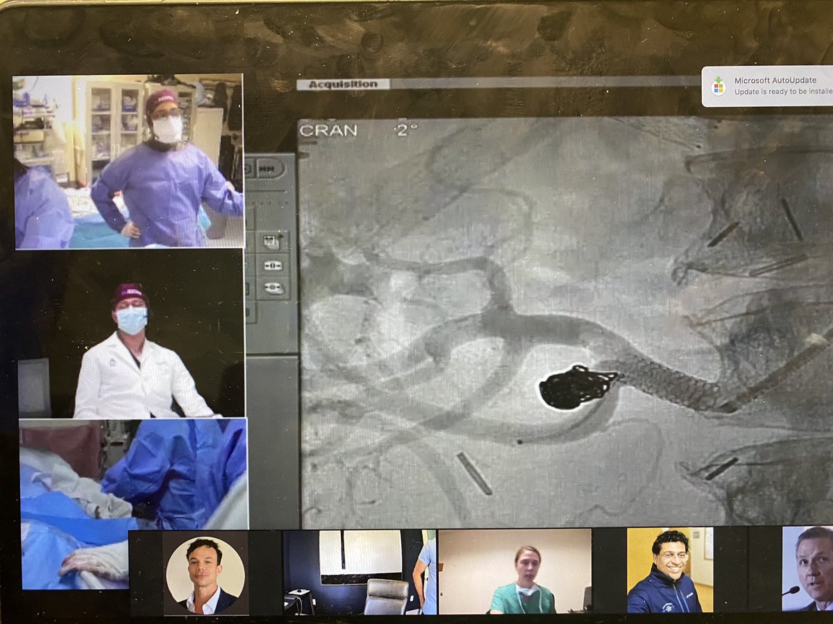 Brandon Olivieri (@bolivierimd) on Twitter photo #TREAT20 <a href="/MountSinaiIR/">Mount Sinai IR</a>
Awesome Cases: ICA aneurysm, Wide-mouthed renal artery aneurysm, RCC embo, Splenic artery aneurysm, etc etc etc
Great Learning on great cases! #TREAT20 <a href="/MountSinaiIR/">Mount Sinai IR</a>
Awesome Cases: ICA aneurysm, Wide-mouthed renal artery aneurysm, RCC embo, Splenic artery aneurysm, etc etc etc
Great Learning on great cases!