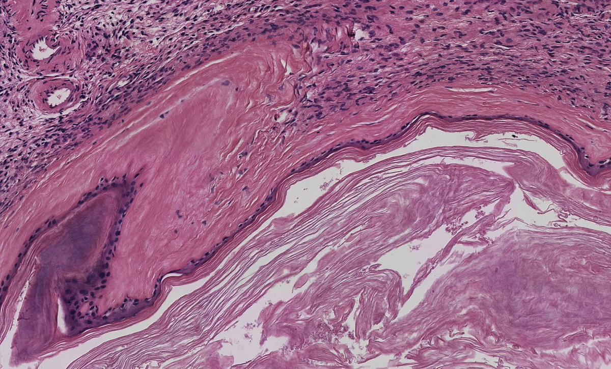 here's a #GYNpath you don't 👀 everyday:
middle-aged F, ovarian tumor cystectomy

▶️ovarian epidermoid cyst
👉🏽NOT dermoid cyst/mature teratoma
👉🏽ovarian cyst lined exclusively by mature squamous epithelium