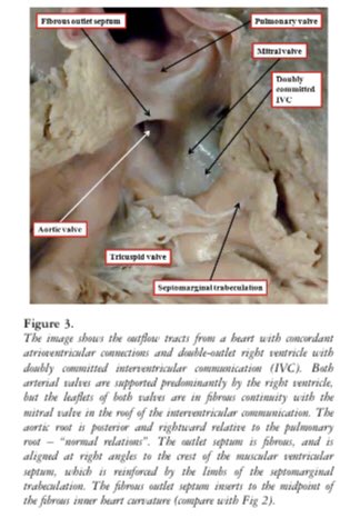 cardiopedhnn's tweet photo. @ajad83 @DrCarlosGtzTor Abordaje de R. Anderson et al: 
-#DSVD es solo un tipo de “conexión V-Art.” y no un tipo de cardiopatía especifica
- el cabalgamiento > 50 % del anillo Valv. semilunar en el septum IV define la relación ventricular 
-puede haber continuidad mitro-Ao

https://t.co/LGNOxMlaWD

#CHD https://t.co/xikM0P2D9T