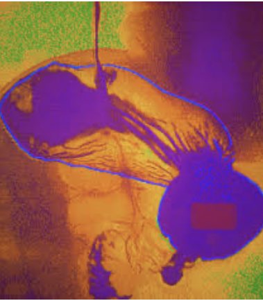 Toward a unified theory of occurrence and recurrence of hiatal hernia 

<a href="/SurgJournal/">SURGERY Journal</a> @ELSSurgery <a href="/USFsurgery/">USF General Surgery</a> #SoMe4Surgery 

surgjournal.com/article/S0039-…