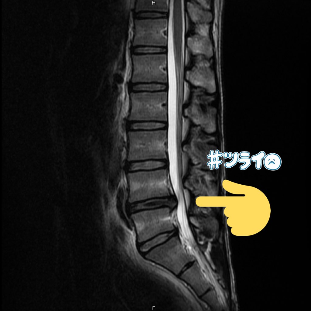 P乙 汰瑯 On Twitter 椎間板ヘルニア手術後報告 椎間板ヘルニアの手術から約3ヶ月経ちました Mri検査を受けたところ 順調に回復していることがわかりました ここまで神経が復活してヘルニアの症状も残ってないのは珍しいことだそう やったー 誰かの希望に