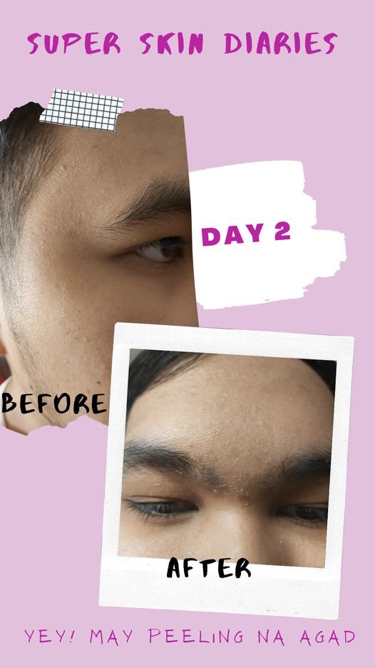 SuperSkinPH's tweet photo. Real Testimonials of Super Skin users like my son David

"SUPER SKIN DIARIES"

You can already feel the difference on your first wash. You will be excited daily on your skin's improvements. Small bumps were minimized and micro peeling starts early as in day 3.
#Superskin https://t.co/A59FkRem6n