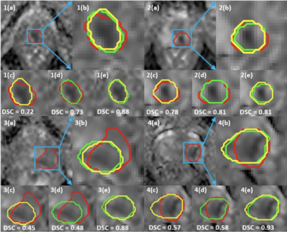 Test-retest repeatability of a deep learning architecture in detecting and segmenting clinically significant #ProstateCancer on apparent diffusion coefficient (ADC) maps. #BeyondTheAbstract on UroToday &gt; bit.ly/2FaM58B <a href="/amogh3892/">Amogh Hiremath</a> @ESR_Journals <a href="/myESR/">myesr</a> @rakesh_s87