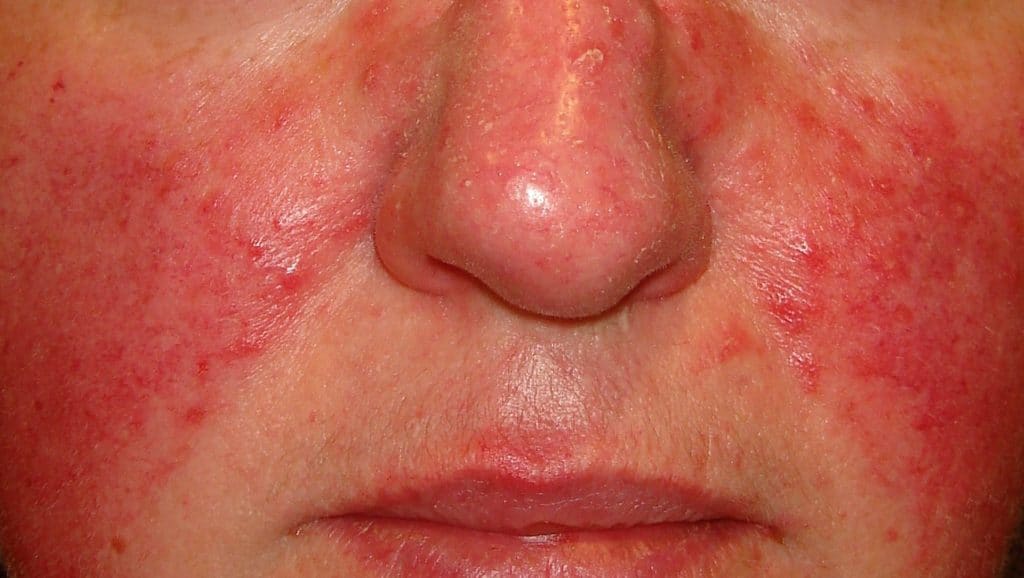 ROSACEA SKIN, what is? 