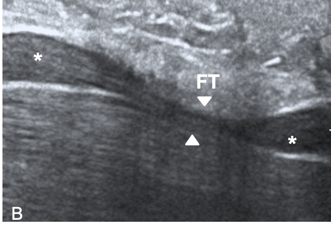 ClinicalNeuroph's tweet image. [Neuromuscular ultrasound glossary] Short axis and long axis ultrasound view of the median nerve.  

doi.org/10.1016/j.clin…
@AANEMorg
#LongAxis #Ultrasound #Neuromuscular #ClinicalNeuroph