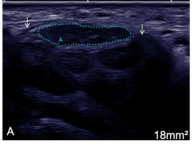 ClinicalNeuroph's tweet image. [Neuromuscular ultrasound glossary] Short axis and long axis ultrasound view of the median nerve.  

doi.org/10.1016/j.clin…
@AANEMorg
#LongAxis #Ultrasound #Neuromuscular #ClinicalNeuroph