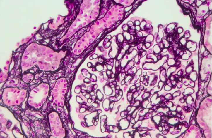 com_SFNDT's tweet photo. C'est parti pour le Club de Pathologie Rénale #SFNDT20 
@ClubPathoRein 

1- Première observation par @Ijeb. Femme 22 ans, obésité, protéinurie glomérulaire, bilan immuno et PLA2R neg. 
IF sans glomérule => Quel est votre diagnostic ?

Fil par @LucileFigueres https://t.co/XUHykyPIZb