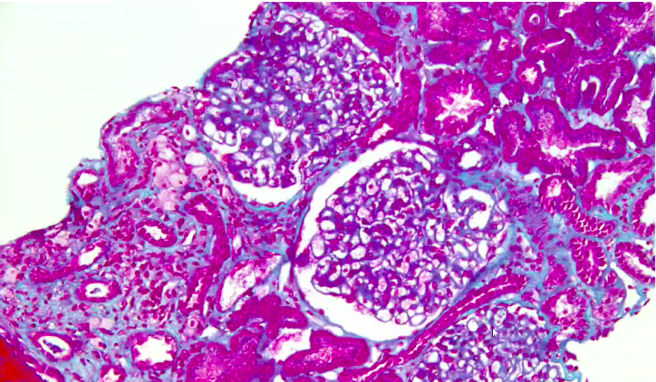 com_SFNDT's tweet photo. C'est parti pour le Club de Pathologie Rénale #SFNDT20 
@ClubPathoRein 

1- Première observation par @Ijeb. Femme 22 ans, obésité, protéinurie glomérulaire, bilan immuno et PLA2R neg. 
IF sans glomérule => Quel est votre diagnostic ?

Fil par @LucileFigueres https://t.co/XUHykyPIZb