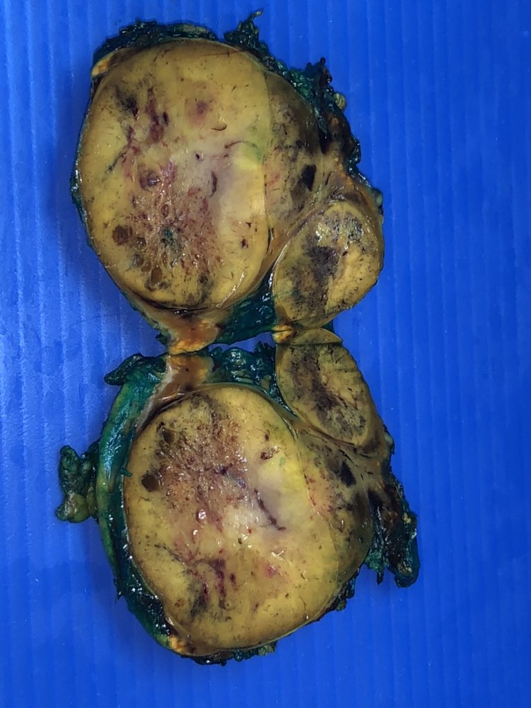 11 year old boy, bilateral adrenalectomy. Gross diagnosis? Further recommendations? #adrenal #surrenal #grossognosis #endocrine