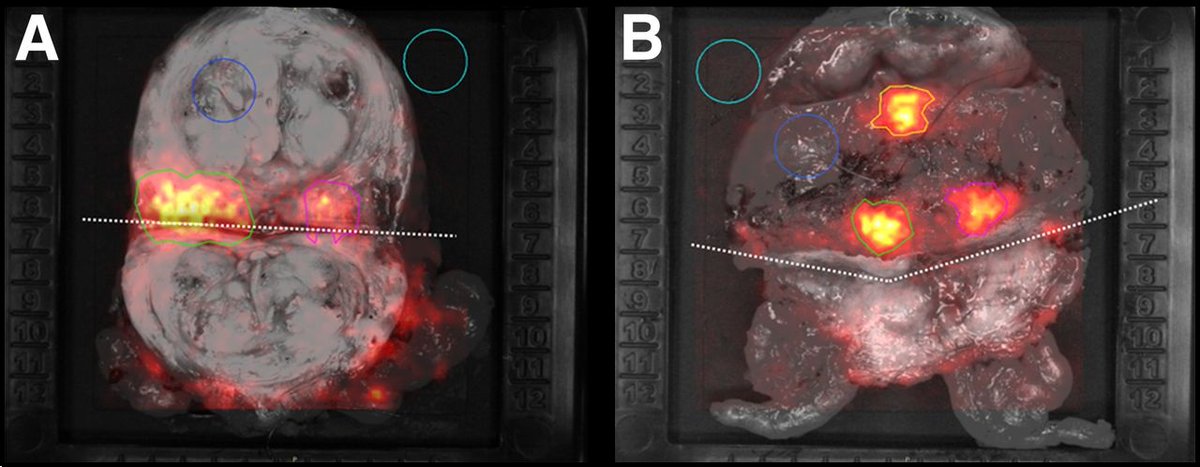 A new intraoperative imaging technique, Cerenkov luminescence imaging, can accurately assess surgical margins during radical prostatectomy, according to research in The Journal of Nuclear Medicine. #ProstateCancer #PrecisionMedicine #NuclearMedicine #JNM snmmi.org/NewsPublicatio…