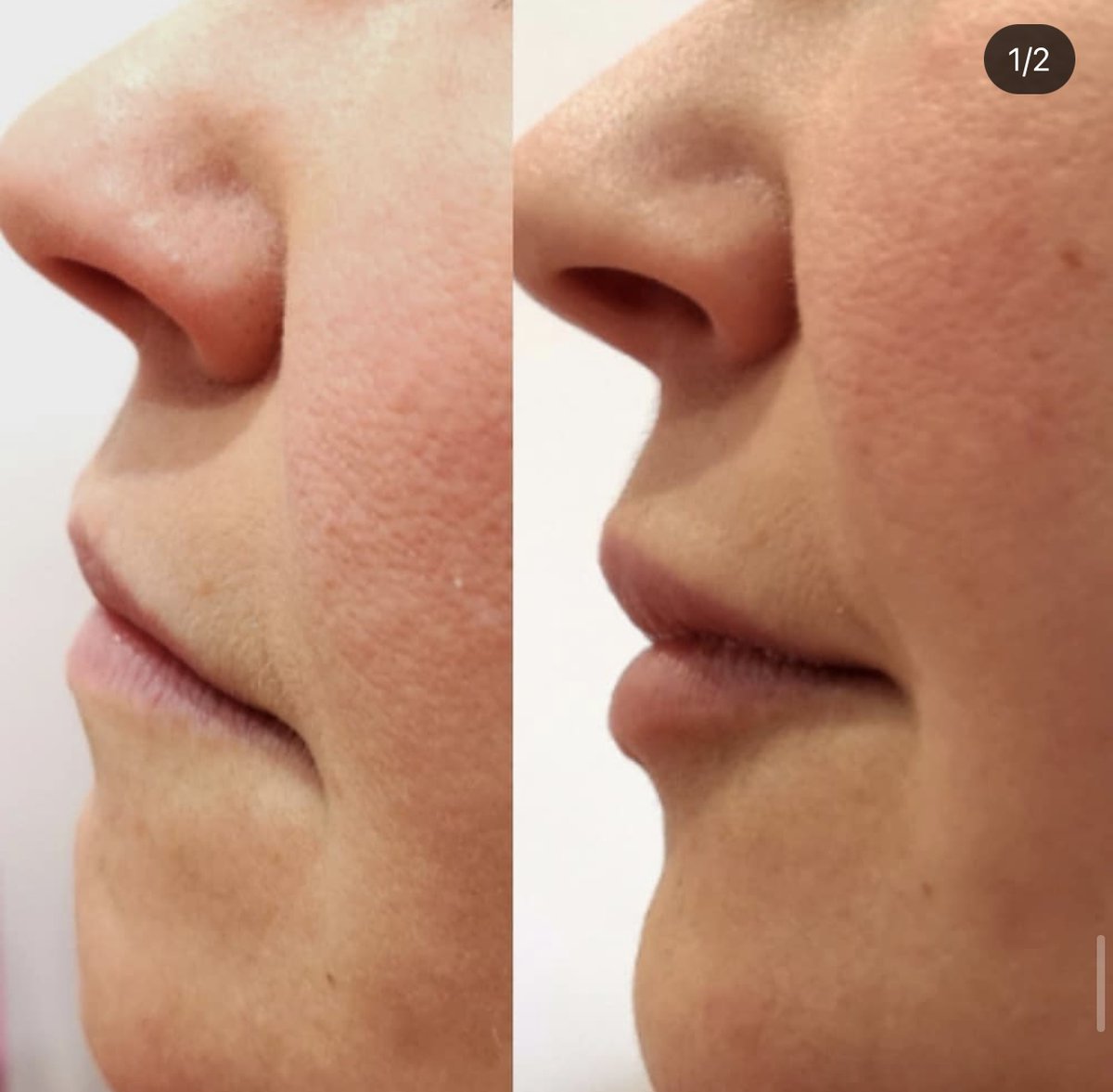 SkinHD_UK's tweet photo. Results of lip enhancement with Juvederm Volift. They look so natural when you see them straight on, but on side profile the increased projection is astounding.  #nurseinjector #facialaesthetics #beforeandafter #lipinjections #lipenhancement #naturalresults ##manchester #Chorlton https://t.co/X9Nc98bd62