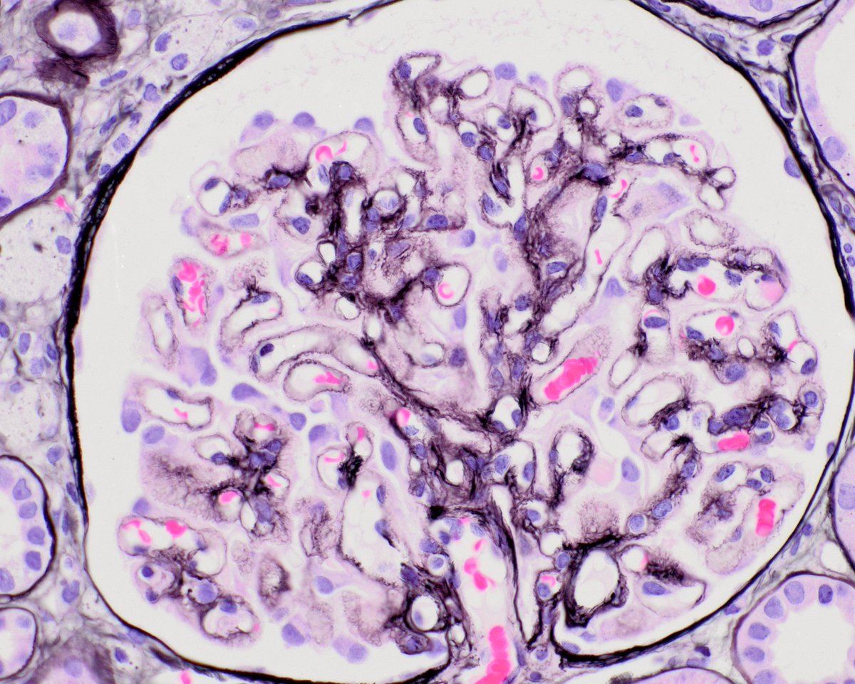 MessiasNidia's tweet image. A simple classic case, because if you need to know something for path and nephrology boards in renal path, you need to know about PLA2R positive membranous. It was a game changer. For patient care too.  It all started here nejm.org/doi/full/10.10…
