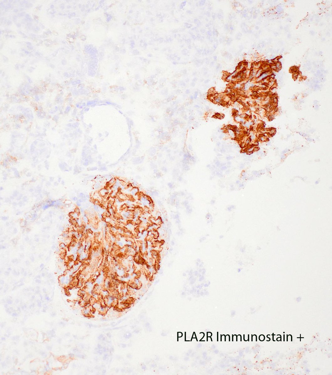 MessiasNidia's tweet image. A simple classic case, because if you need to know something for path and nephrology boards in renal path, you need to know about PLA2R positive membranous. It was a game changer. For patient care too.  It all started here nejm.org/doi/full/10.10…