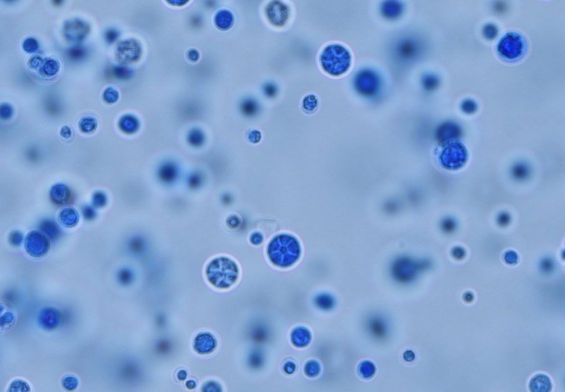 Q: (1/2)35/Farmer from Missouri AML s/p HSCT 6m ago. GVHD on steroids. Admitted with sepsis. (-) travel. CXR clear. WBC 7K . ANC 1.5K. Eczema like lesions on leg. (See next thread)