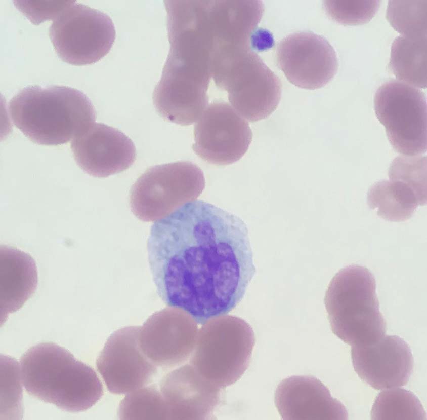 AmirBehdadMD's tweet image. Even monocytes have had enough with 2020! #hemepath