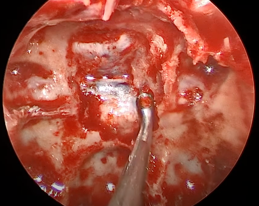NASBSorg's tweet photo. #ent #nsgy #OpVid from Prof. @BradZachariaMD demonstrating the Expanded #Endoscopic Endonasal Resection of Retrochiasmatic Craniopharyngioma #neurosurgery #education #approaches #neuroonc https://t.co/4TqRDW5D7y https://t.co/ANKr0619AM