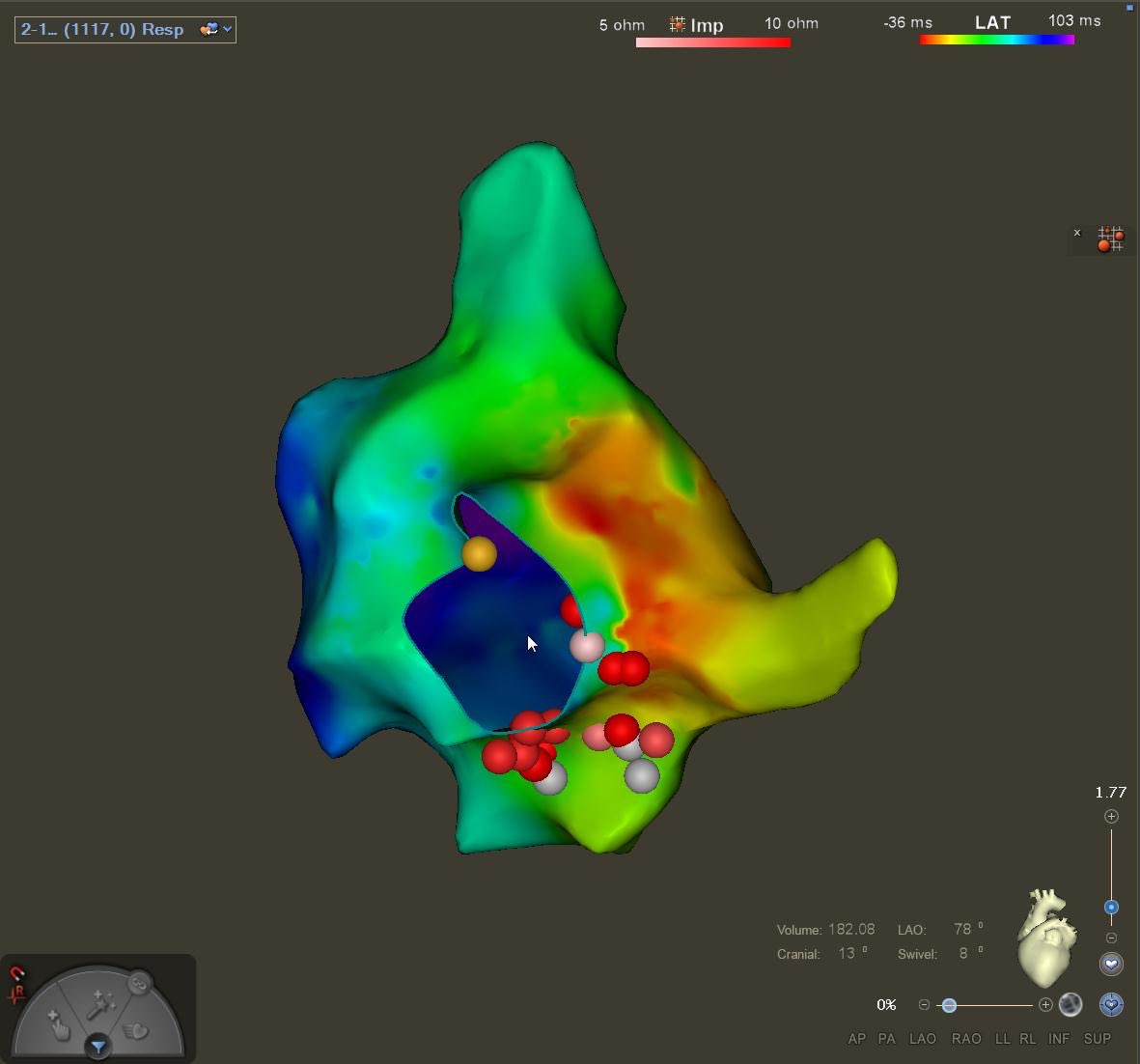 This is the same patient with the atrial septal defect who not surprisingly also had counterclockwise right atrial flutter but surprisingly also had AV node recently tachycardia and a left atrial mitral annular focal tachycardia.