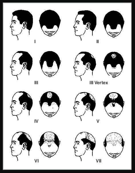 How many "Grafts" will you need for your hair transplant? Can this be easily estimated or "calculated" using an online tool? Most likely not! Click to find out! fellermedical.com/how-many-graft…