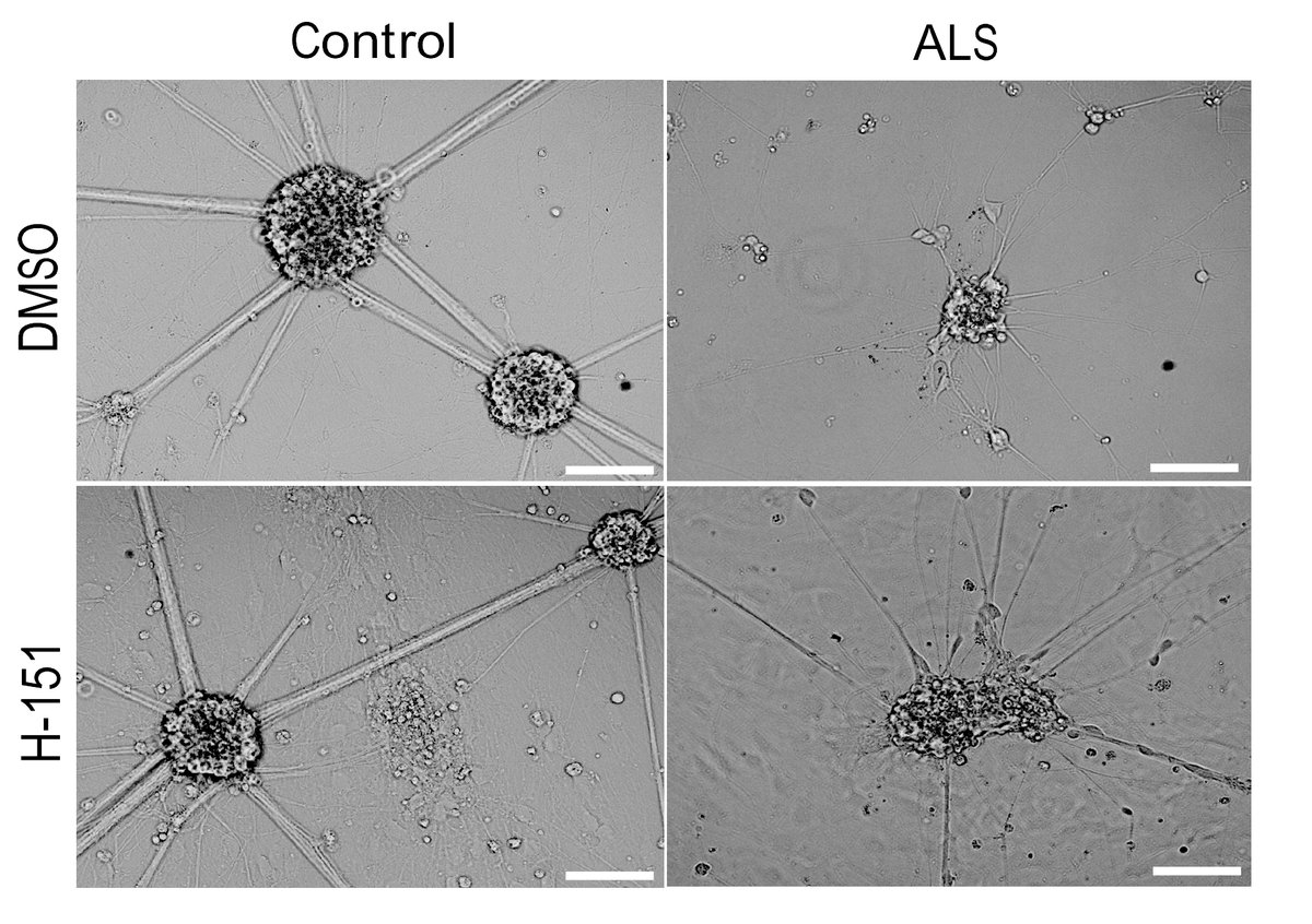 STING inhibitors prevent inflammation due to TDP-43 and promote survival of iPSC derived motor neurons from patients with ALS. Genetic deletion of STING does not affect disease onset, but significantly reduces motor neuron loss and extends lifespan in a preclinical model.