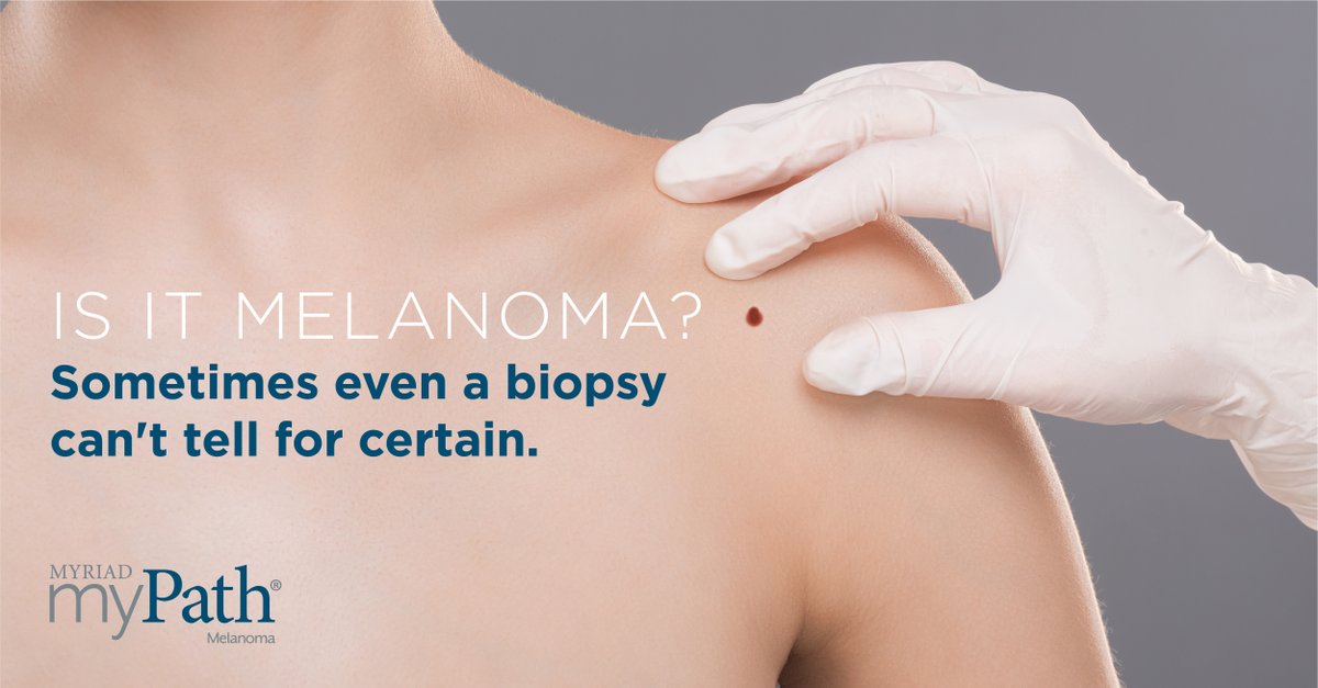 myPathMelanoma's tweet photo. "What do you mean you can't tell if it's #melanoma?" Uncertain diagnoses can be frustrating for both patients and physicians, but not all melanocytic neoplasms can be diagnosed definitively by histopathology alone. How can myPath Melanoma help? Click: https://t.co/ZHkGZGzKfU https://t.co/p9BO2osO7B