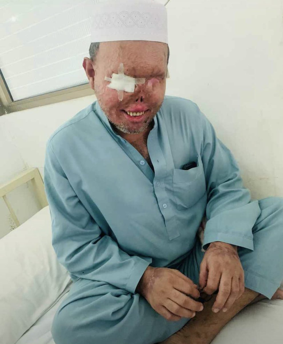 This man (Zafar bhai) was a Rikshaw driver, 2 female passengers were in his rikshaw in saddar Peshawar which were being followed by some men who were teasing those females , He (Riksha driver) resist them not to do so, and in response they Threw ACID on his face due to which +