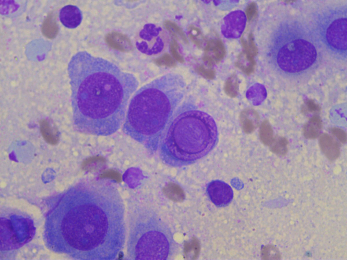rep692's tweet photo. Intranuclear inclusions in adenocarcinoma of the common bile duct, intraoperative material #Intranuclear #inclusions https://t.co/ZCREcW4U7T